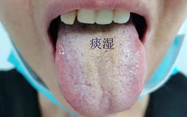舌头上有裂纹?竟是这7种原因导致!医生教你通过舌象参考中成药 - 知乎