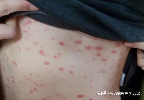 大致可分为三个时期:进行期,静止期和消退期