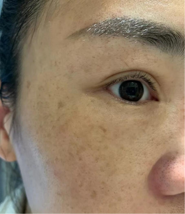 天天用防晒霜还是光老化的厉害,晒斑干纹长满脸…跟着皮肤科医生,原来