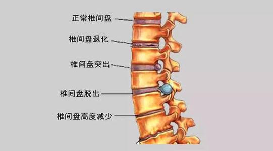 脊柱骨折是这样分型的 细致的疯狂 知乎