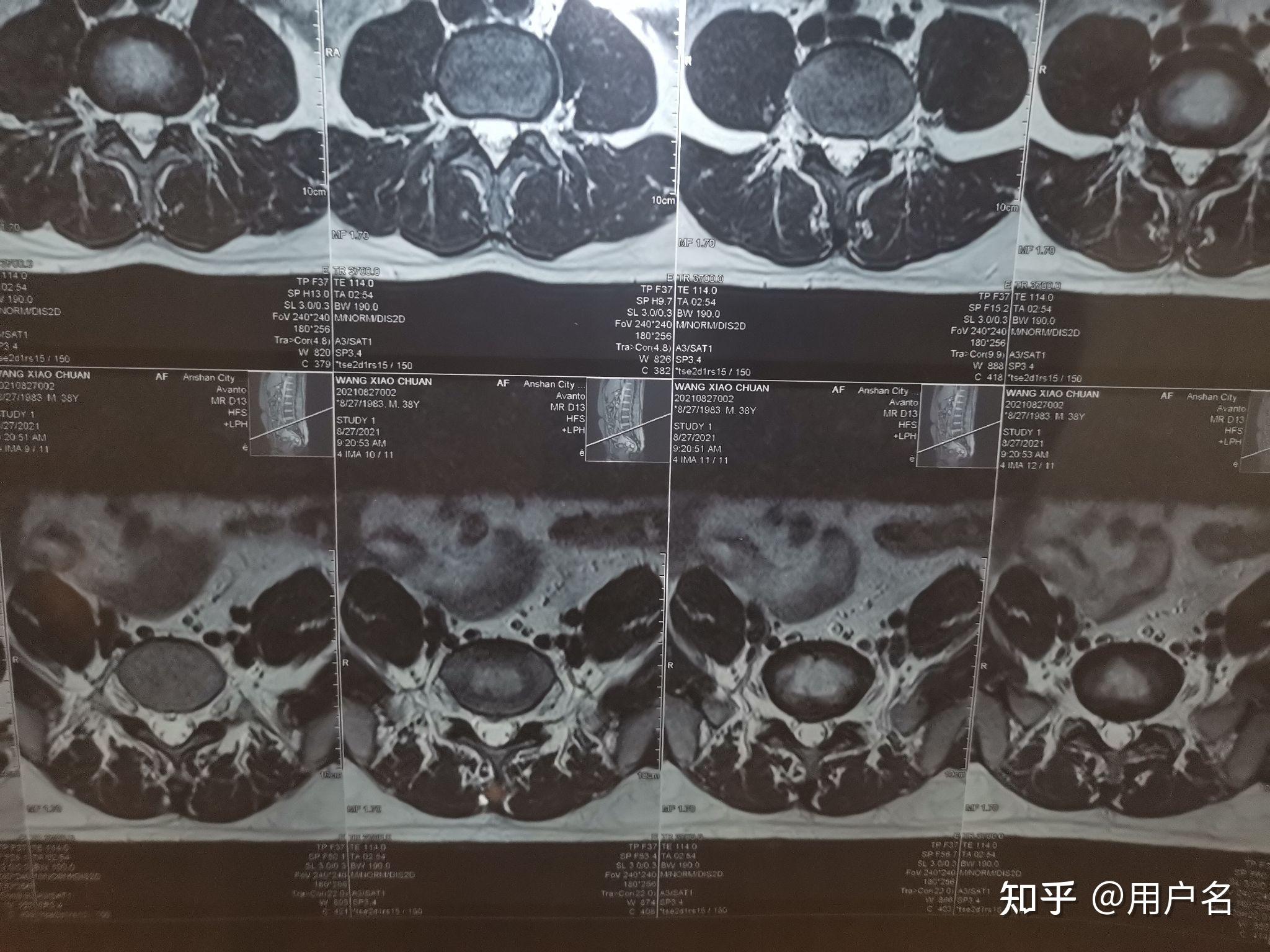 腰椎间盘突出l5s1中央型求帮助