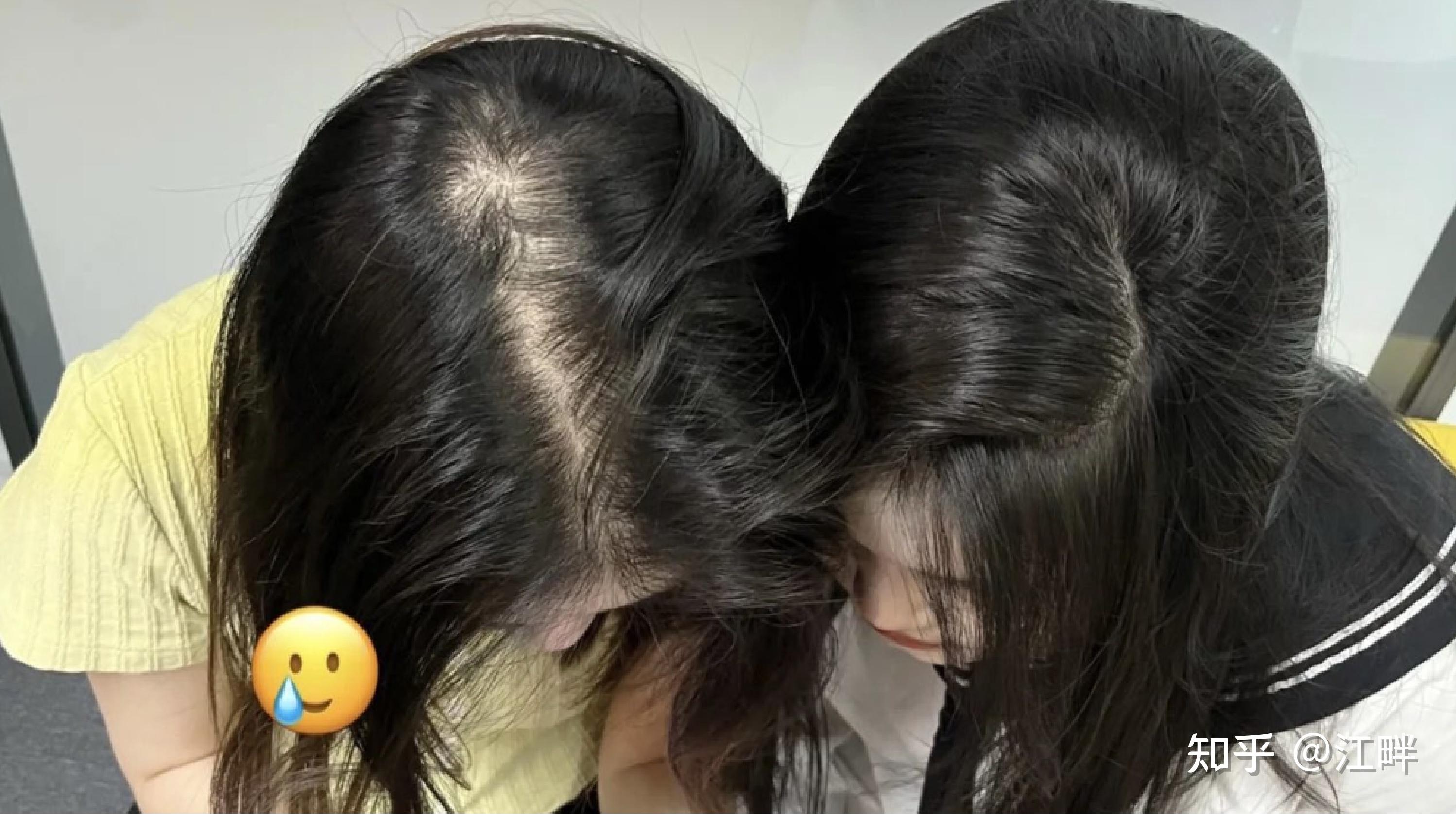 如果你有脱发、掉发、发际线发缝宽、发量少的问题,不妨听一下【三甲皮肤科医生】的建议!! - 知乎