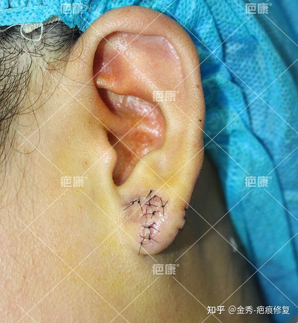 困扰3年的耳朵疤痕疙瘩手术治疗后彻底治愈了
