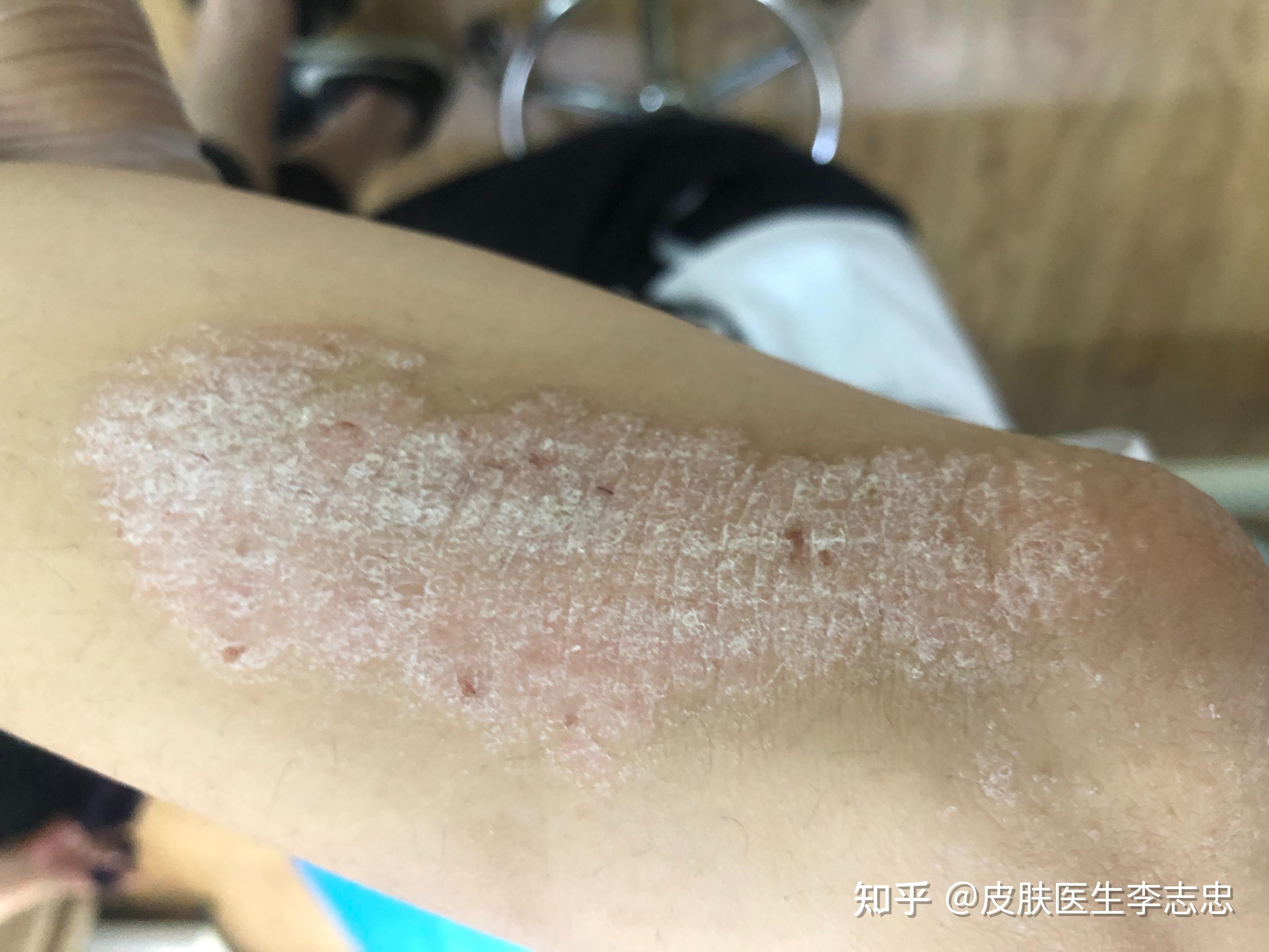 神经性皮炎的中医诊疗! - 知乎