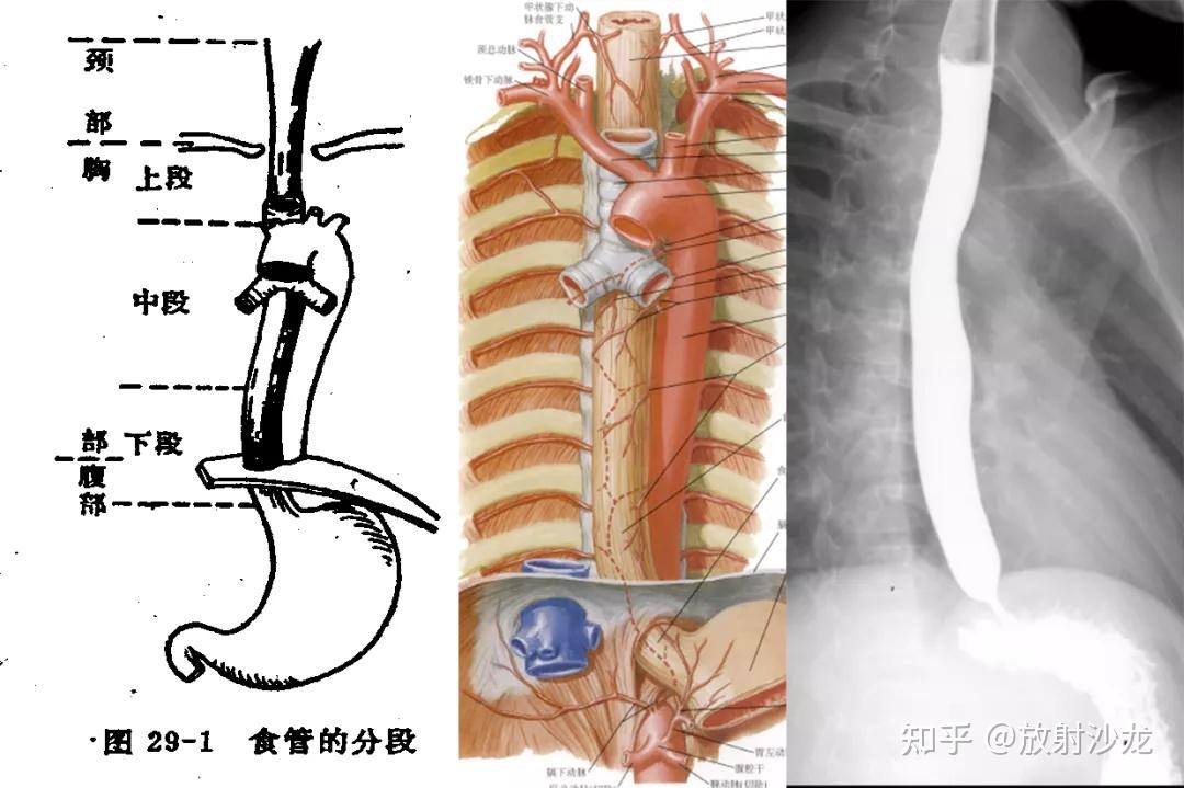 通过病例，一起来学习食管影像解剖和非肿瘤性病变 - 知乎