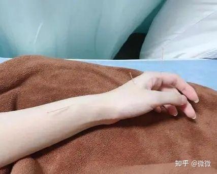 女生手背针灸图片图片