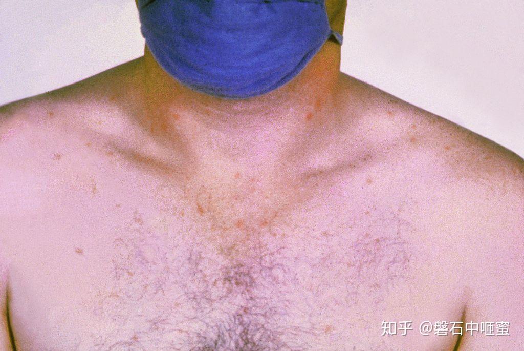 伤寒 Typhoid fever - 知乎