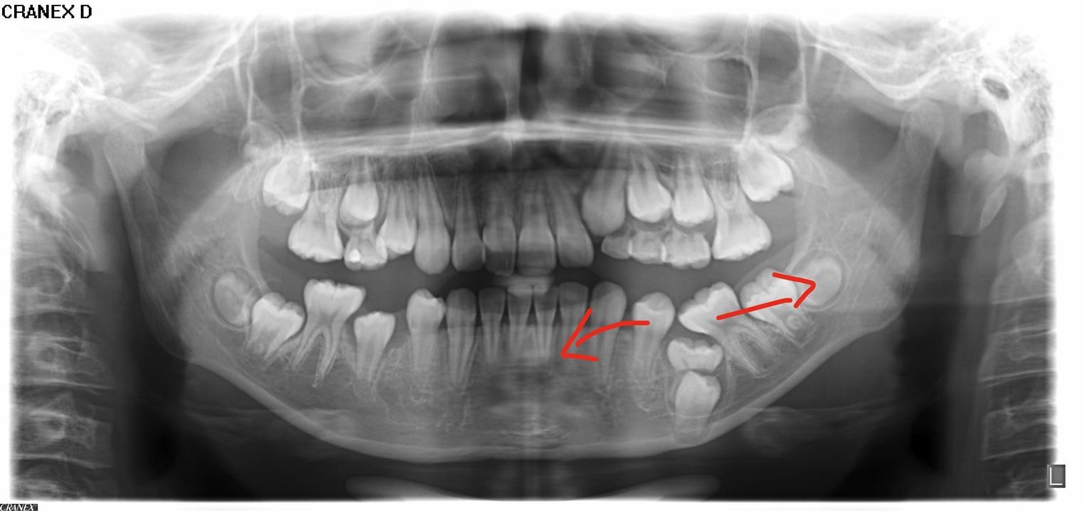 求牙医大神看看我的超超超难拔阻生齿!!??