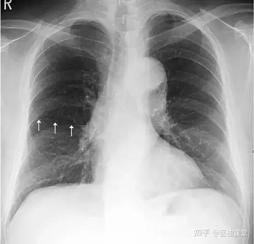 图解正常胸片怎么看? - 知乎
