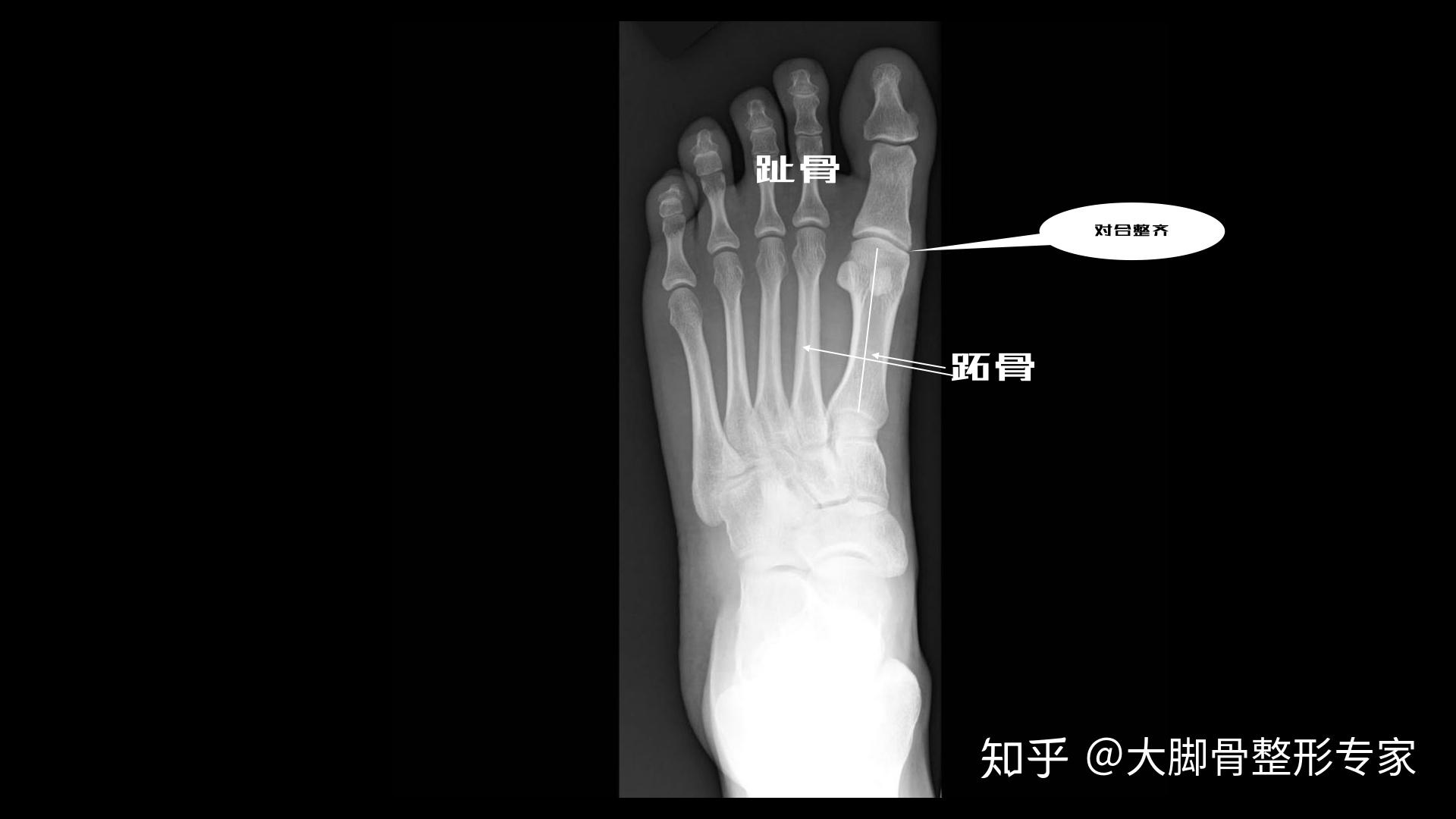 上海虹桥医院科普：关于大脚骨 - 知乎