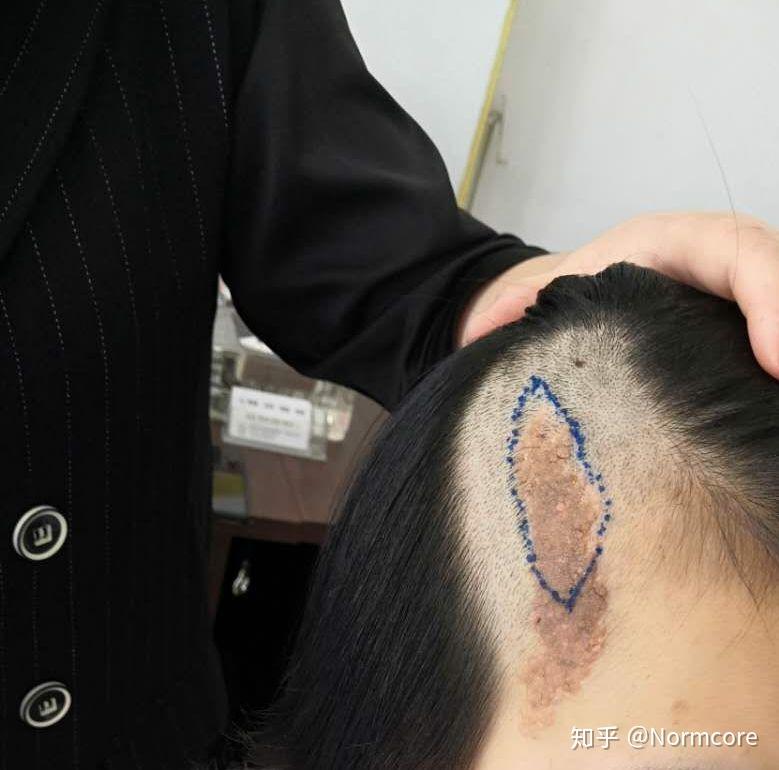 记录一下皮脂腺痣离开自己的过程