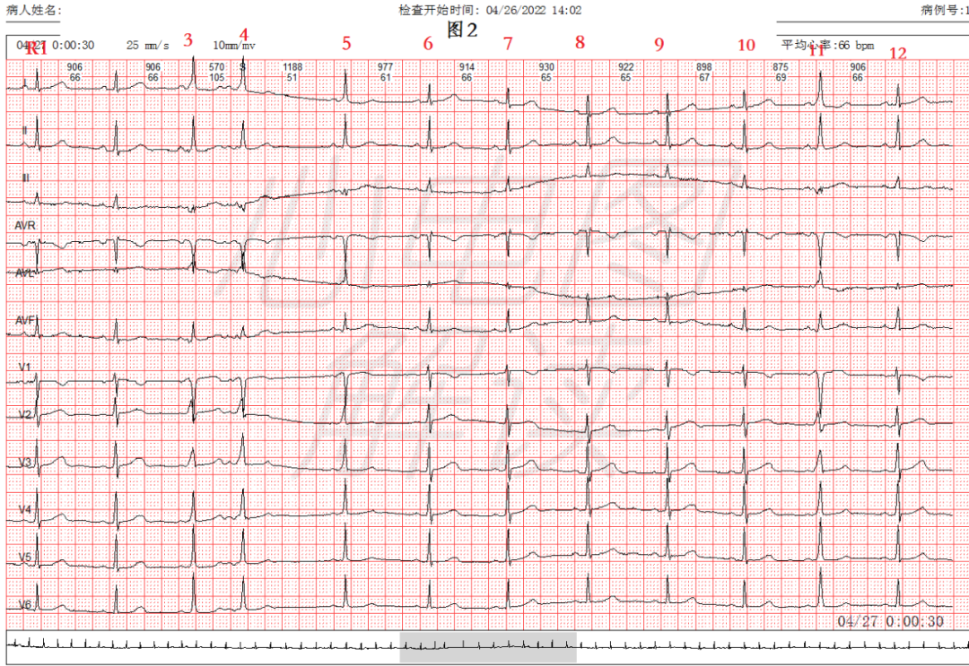 心室预激心电图图片