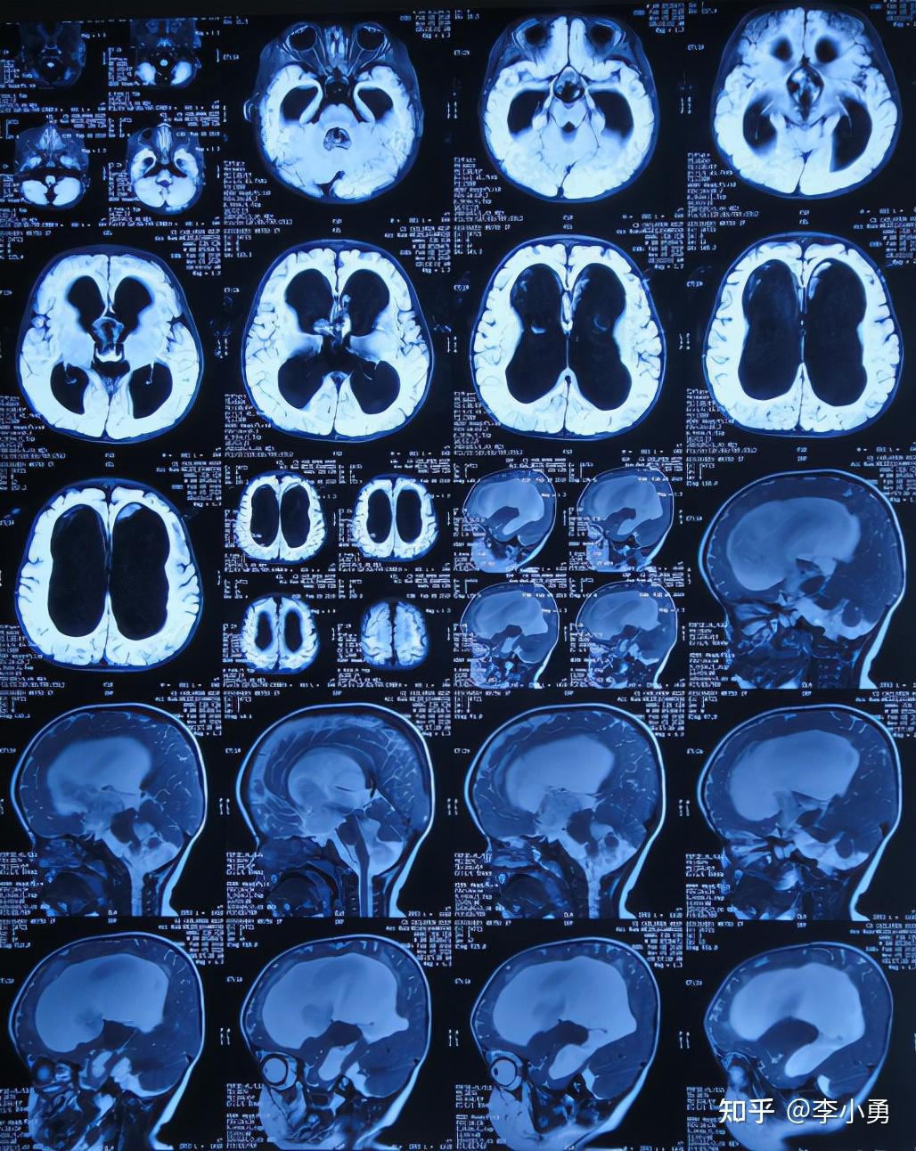 9月大婴儿大头脑积水后直接采用李小勇氏预防分流感染和堵管并发症并