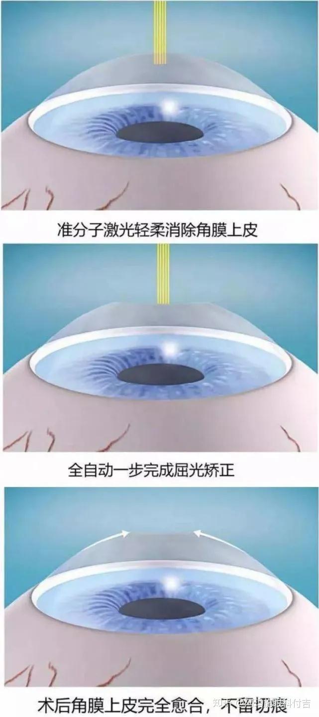 近视眼全激光smart手术的优缺点
