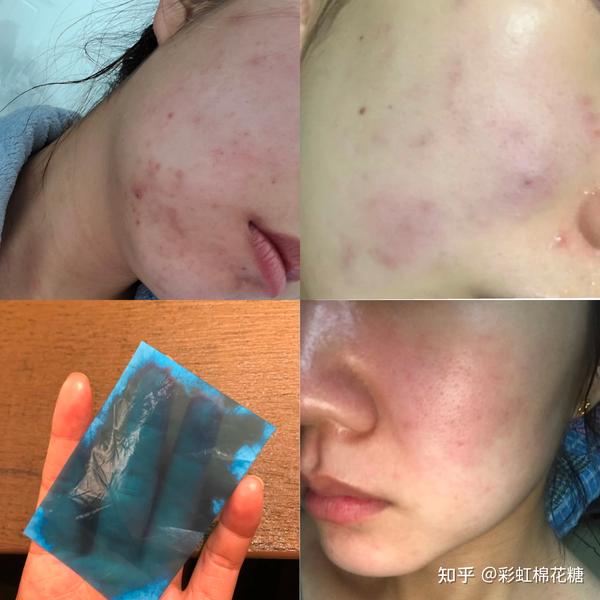 皮肤从满脸痘痘到白里透红是什么体验?