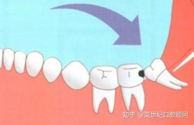 什么是智齿冠周炎? - 知乎