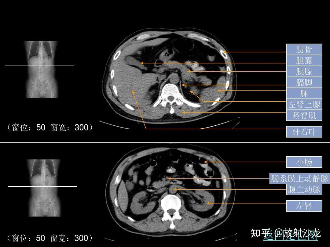 超细的腹部CT入门精美解剖图谱 - 知乎
