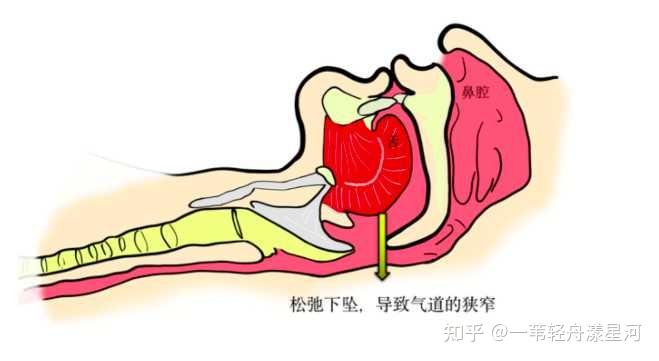 打鼾结构图片