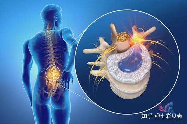 腰间盘突出哪里疼图片图片