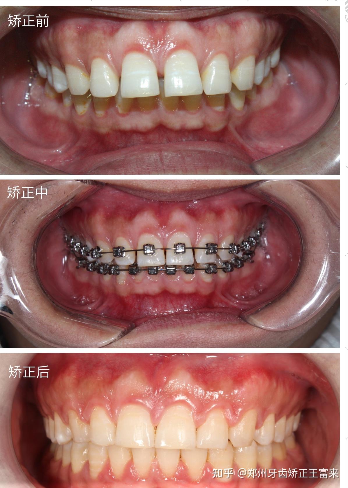 郑州牙齿矫正为什么会出现牙根吸收的情况