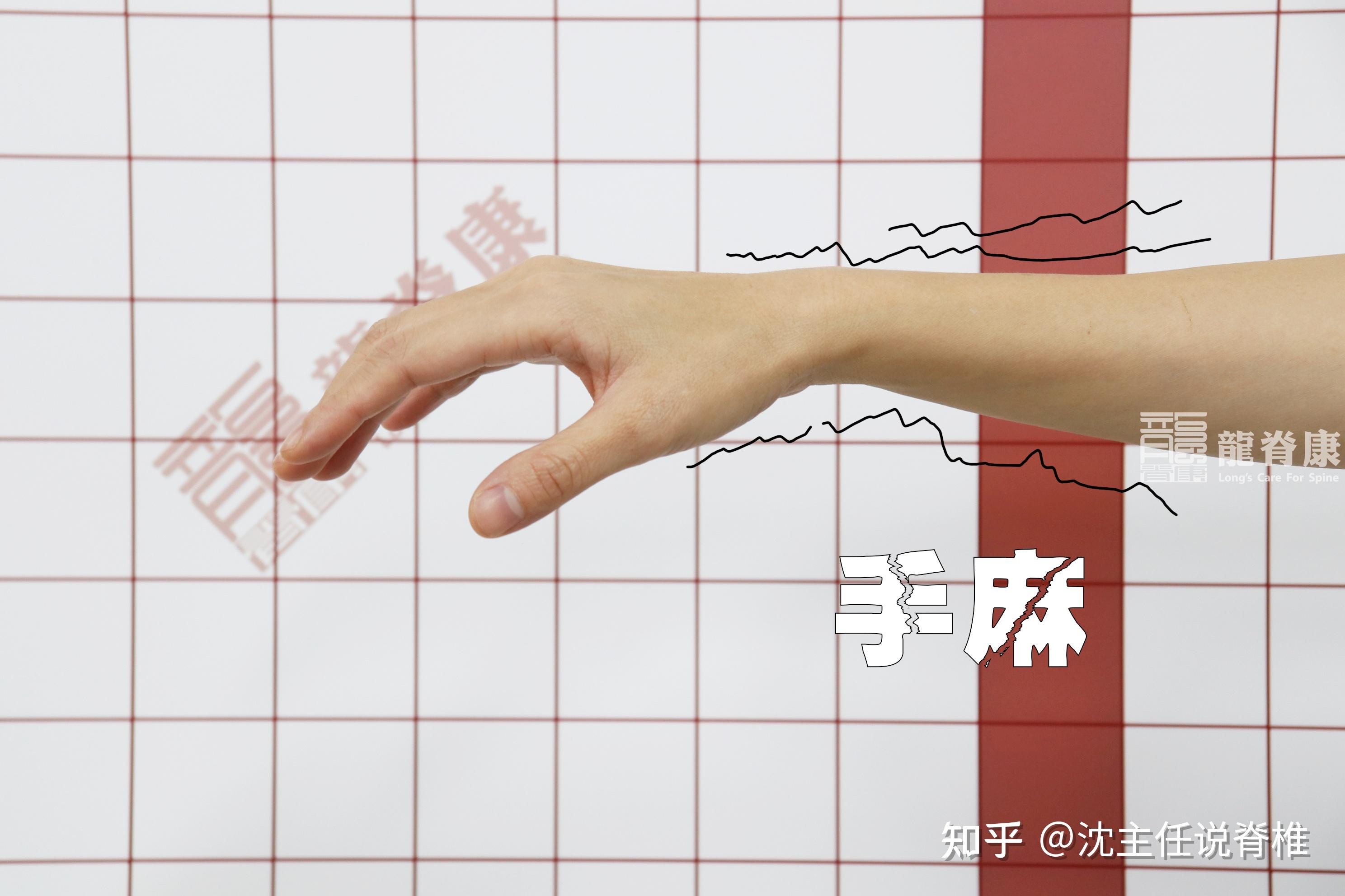 手麻一定是颈椎病吗?医生辟谣,带你了解胸廓出口综合征 - 知乎