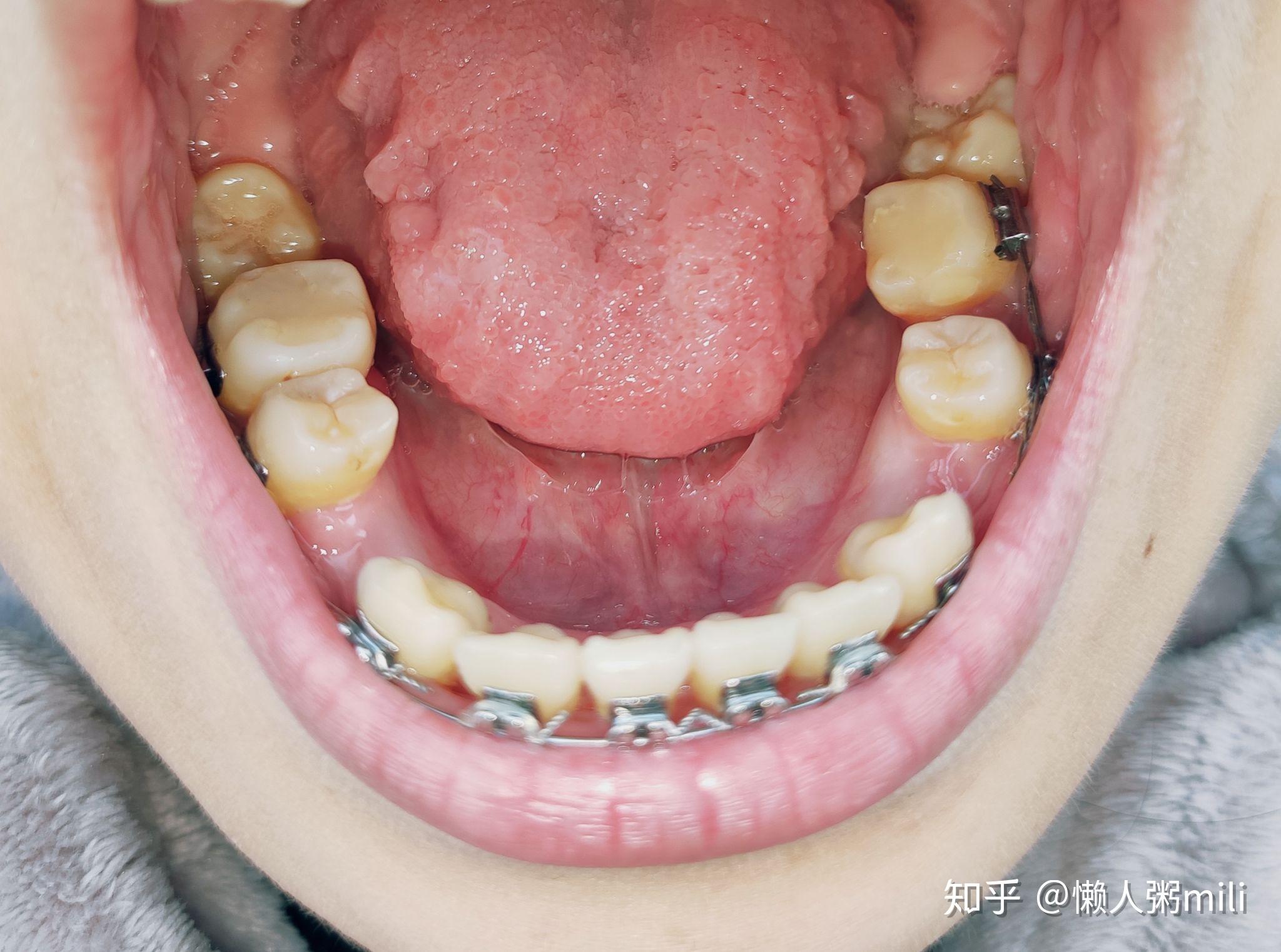 24岁拔磨牙大牙 智齿前移替代7号牙 牙齿矫正记录 - 知乎