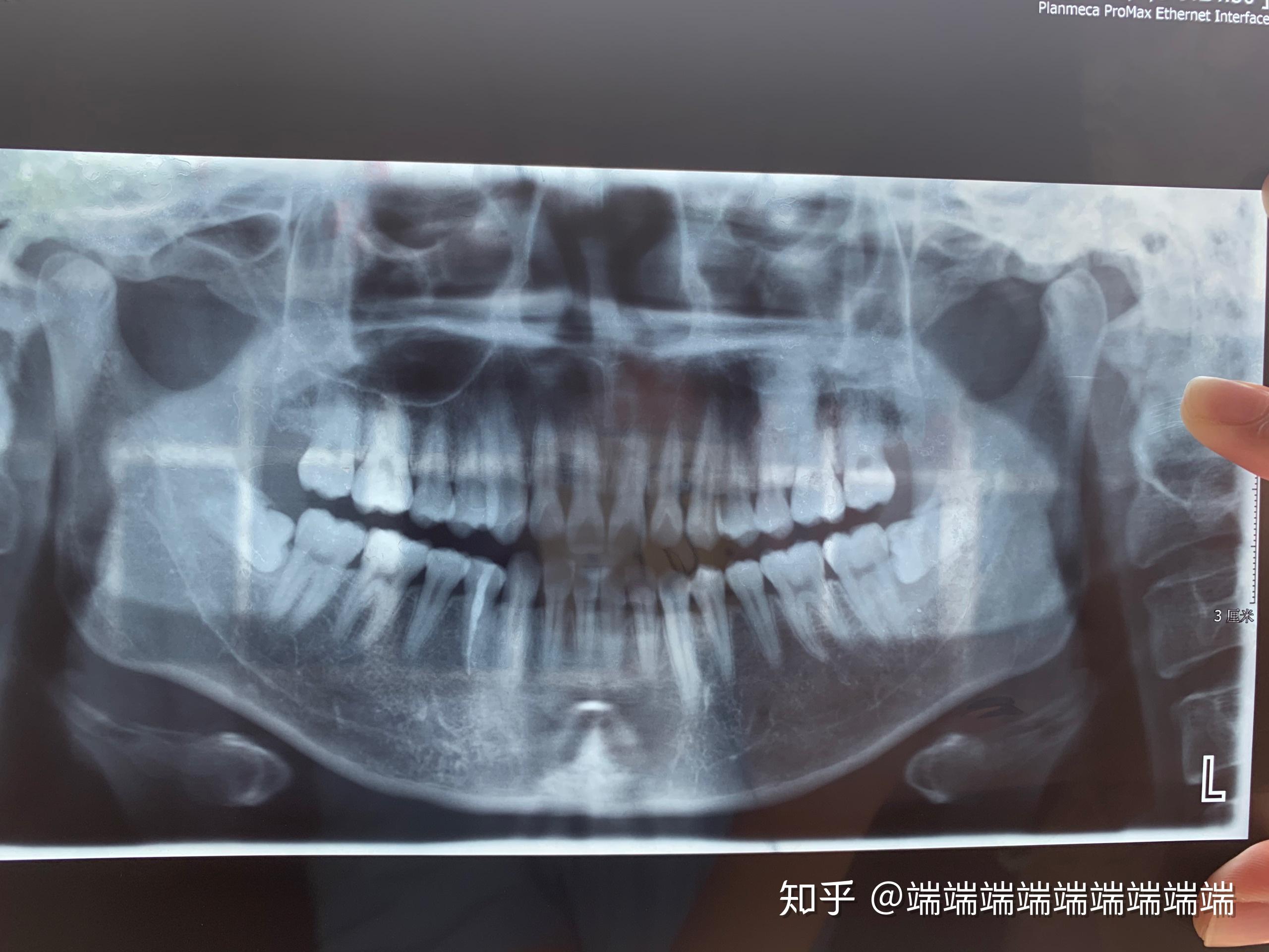 智齿长到上颌窦ct图图片