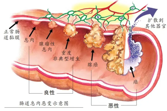 医生也说还好及时发现,不然拖个三五年中招结直肠癌的几率非