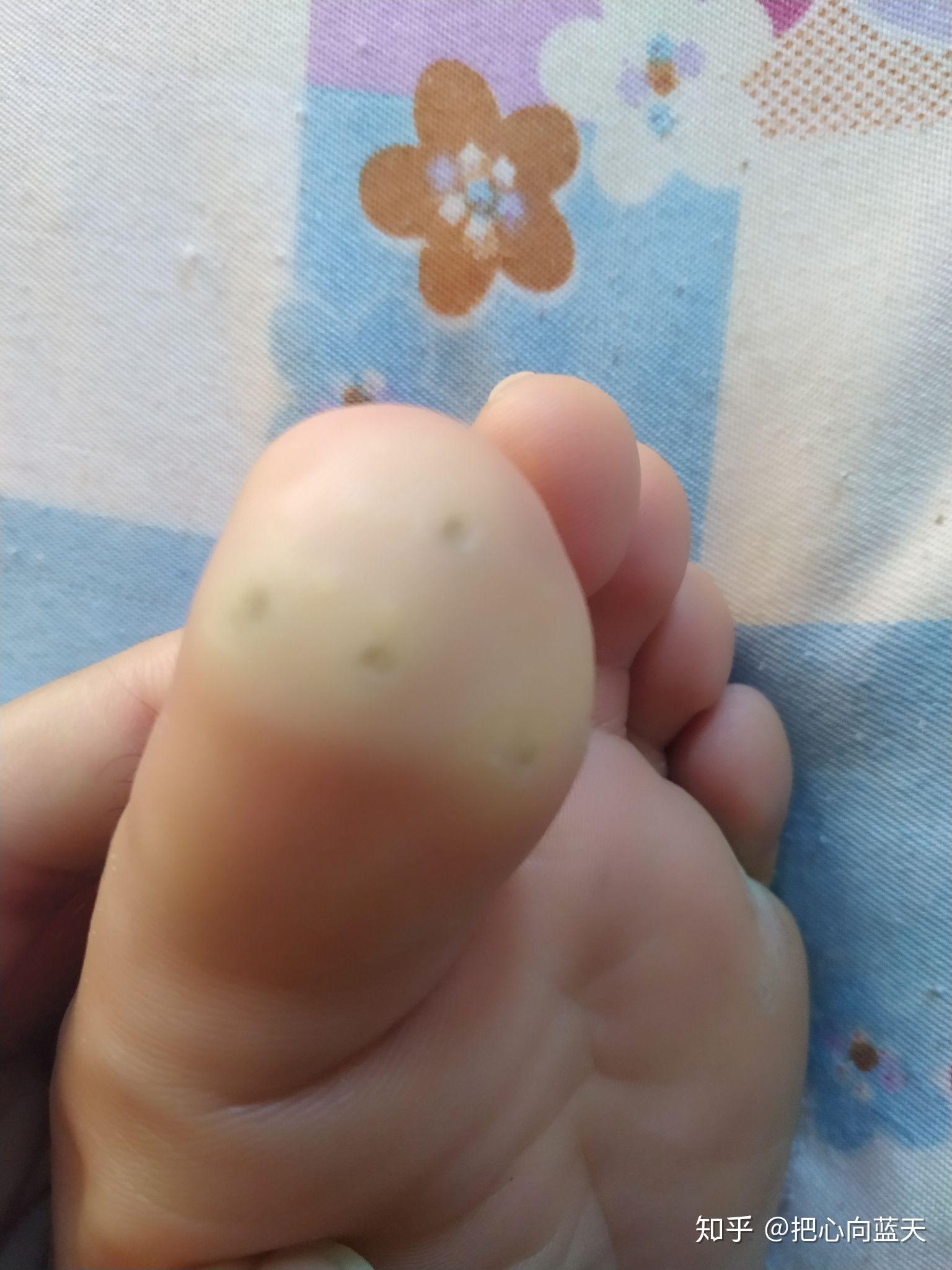 战脚疣之路 - 知乎