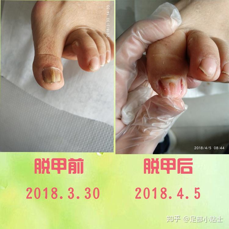 祛除病甲就是脱甲,市面上我们会看到很多脱甲膏,溶甲膏,脱甲精油等都