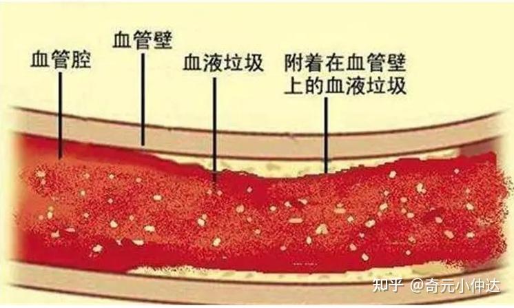 血液粘稠可能有什么表现？ - 知乎