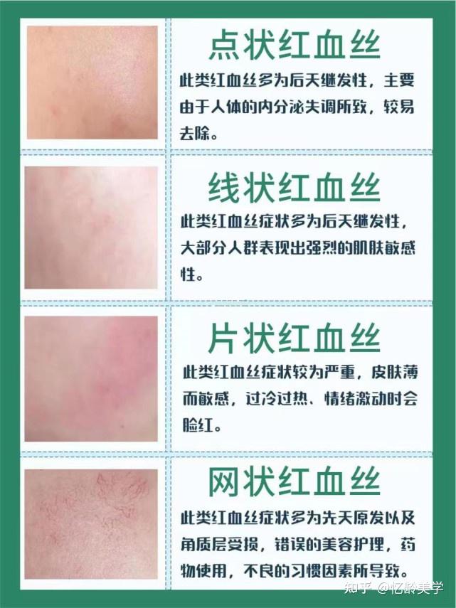 红血丝在医学上称为"微血管扩张症",是由于表皮层太薄,毛细血管扩张