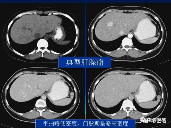 肝细胞腺瘤（HA）的影像学表现 - 知乎