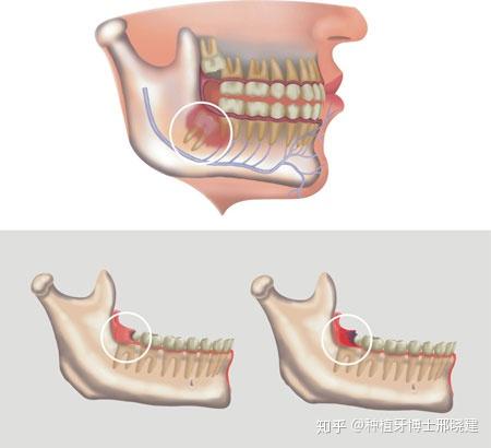 拔智齿后一般会疼多久才算正常 知乎