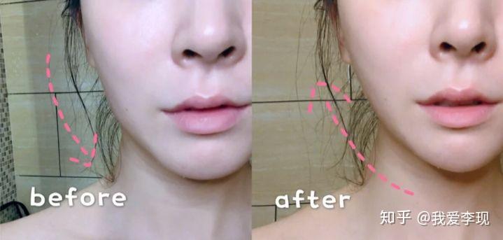 皮肤修复过程中可能的副作用 v2-2959e8ca9ce40c2c890cd40fa9e9b2ef_r.jpg