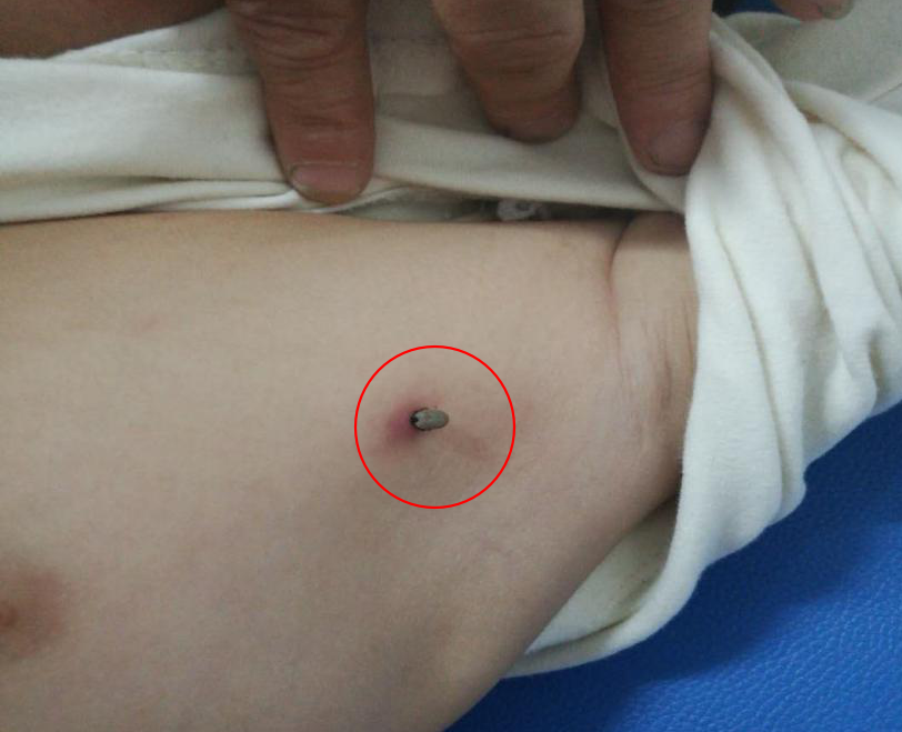 蜱虫钻入宝宝体内半截医生切不可大意严重时可致死