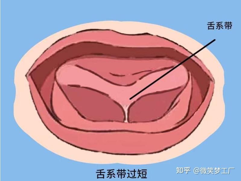 系带成形术示意图图片