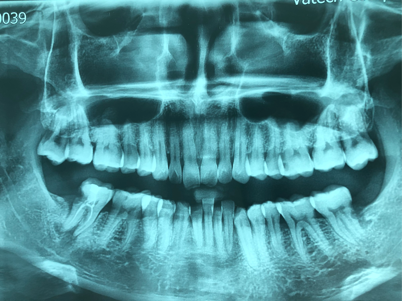 怎样判断牙周炎 牙槽骨吸收程度