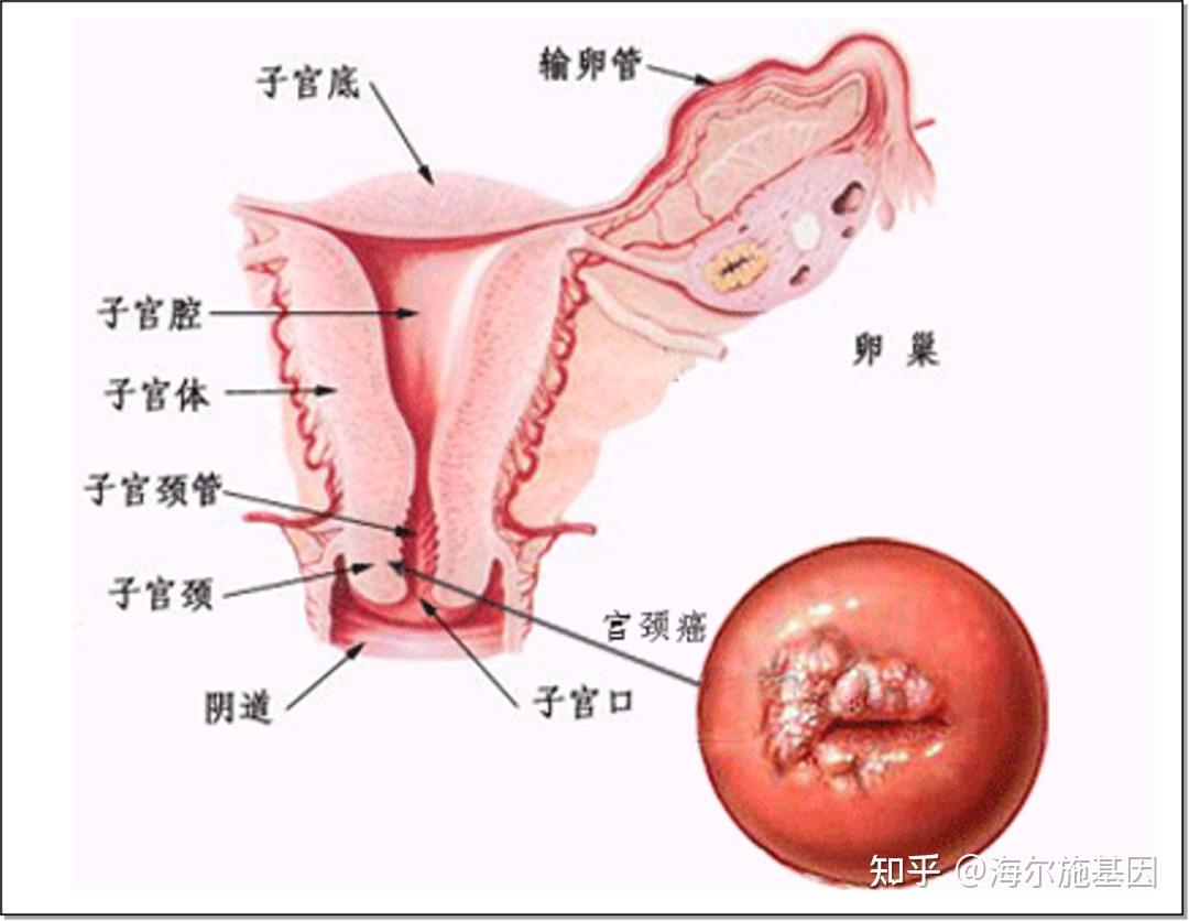 妇女宫颈癌新发病例