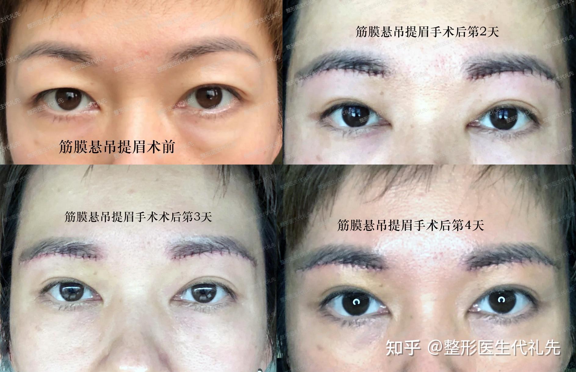 北京面部提升年轻化代礼先医生谈：提眉手术后大家最关心的“疤痕问题”，一起来看案例反馈 - 知乎
