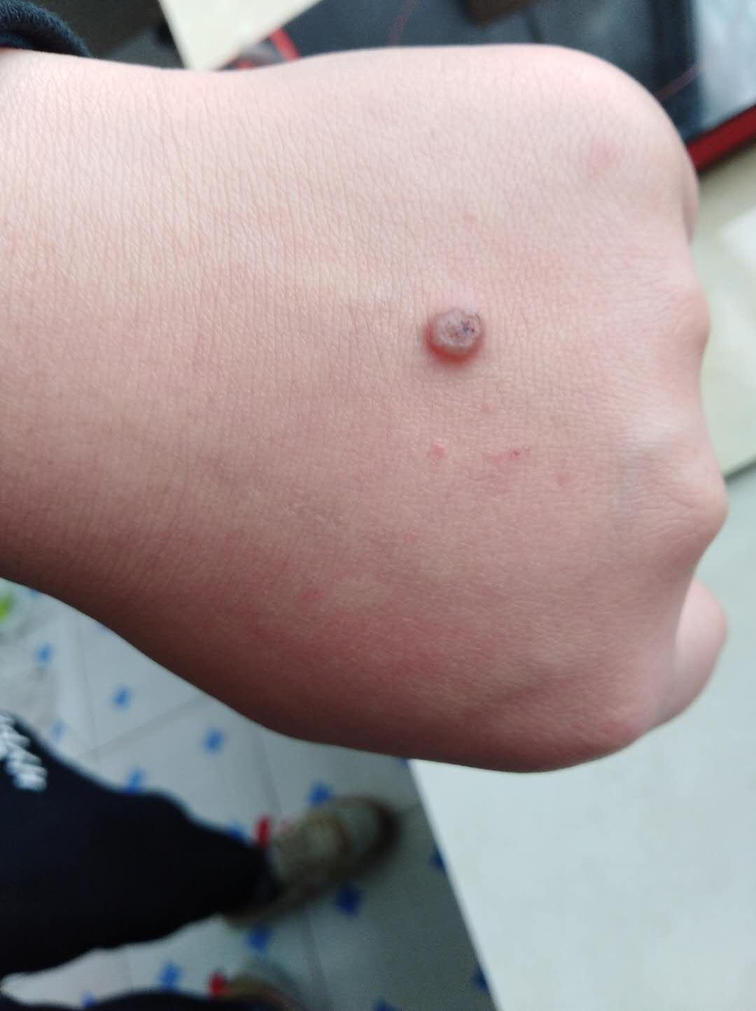 手背面这种小疙瘩如何治疗已经出现3个月了