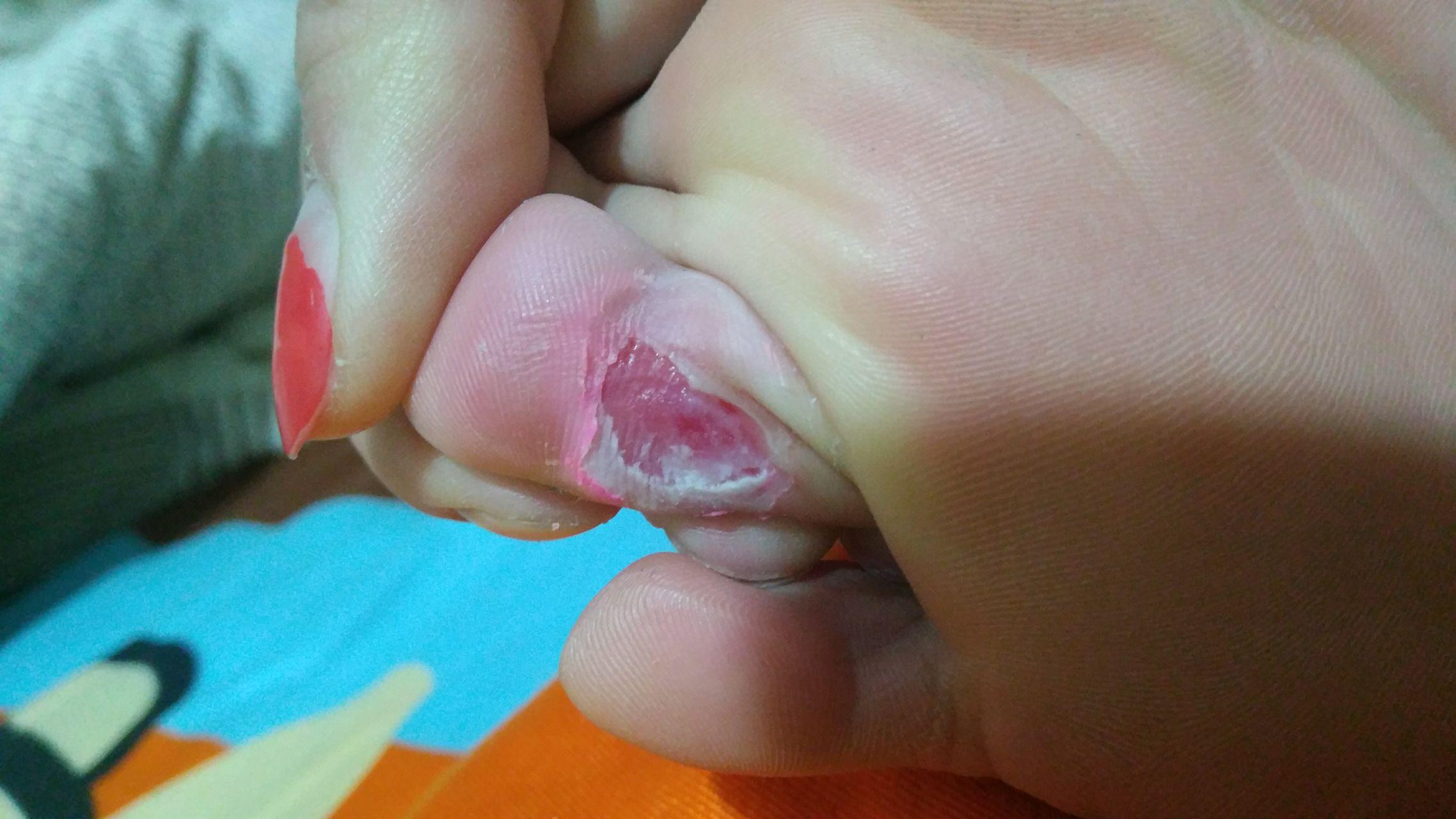 用鸡眼膏贴完就成这样了.没有看见黑色的东西.这样算好了么?