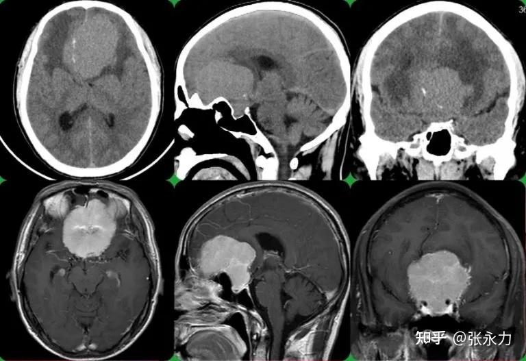 與周圍重要血管神經關係密切,血供豐富,考慮巨大嗅溝腦膜瘤可能,手術