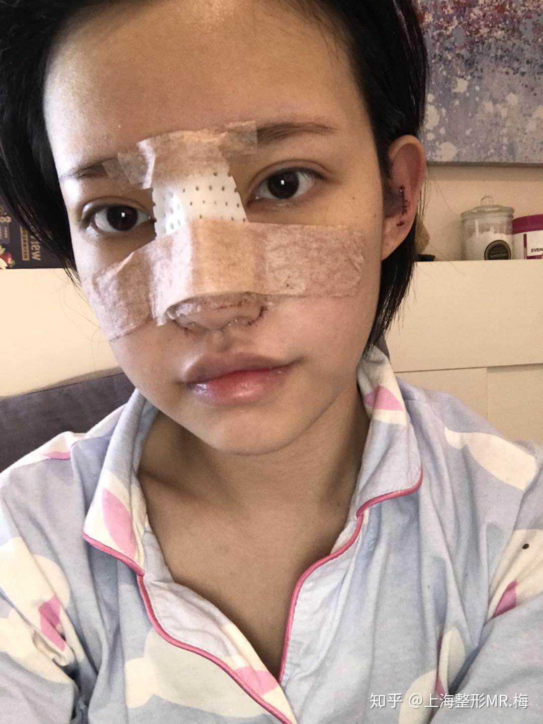 隆鼻老了会怎样有没有后遗症