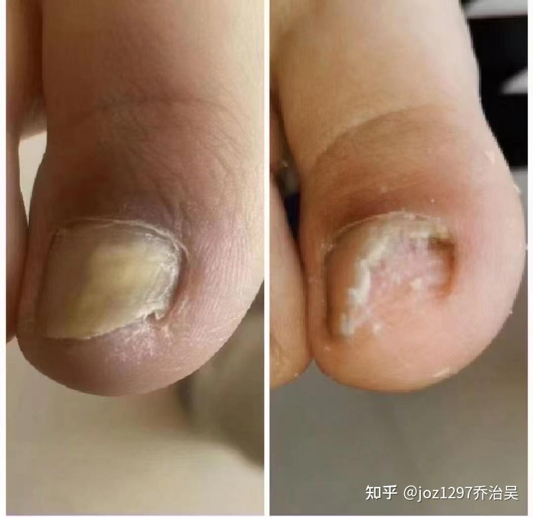 这是灰指甲吗?脚趾甲突然变厚发白了.