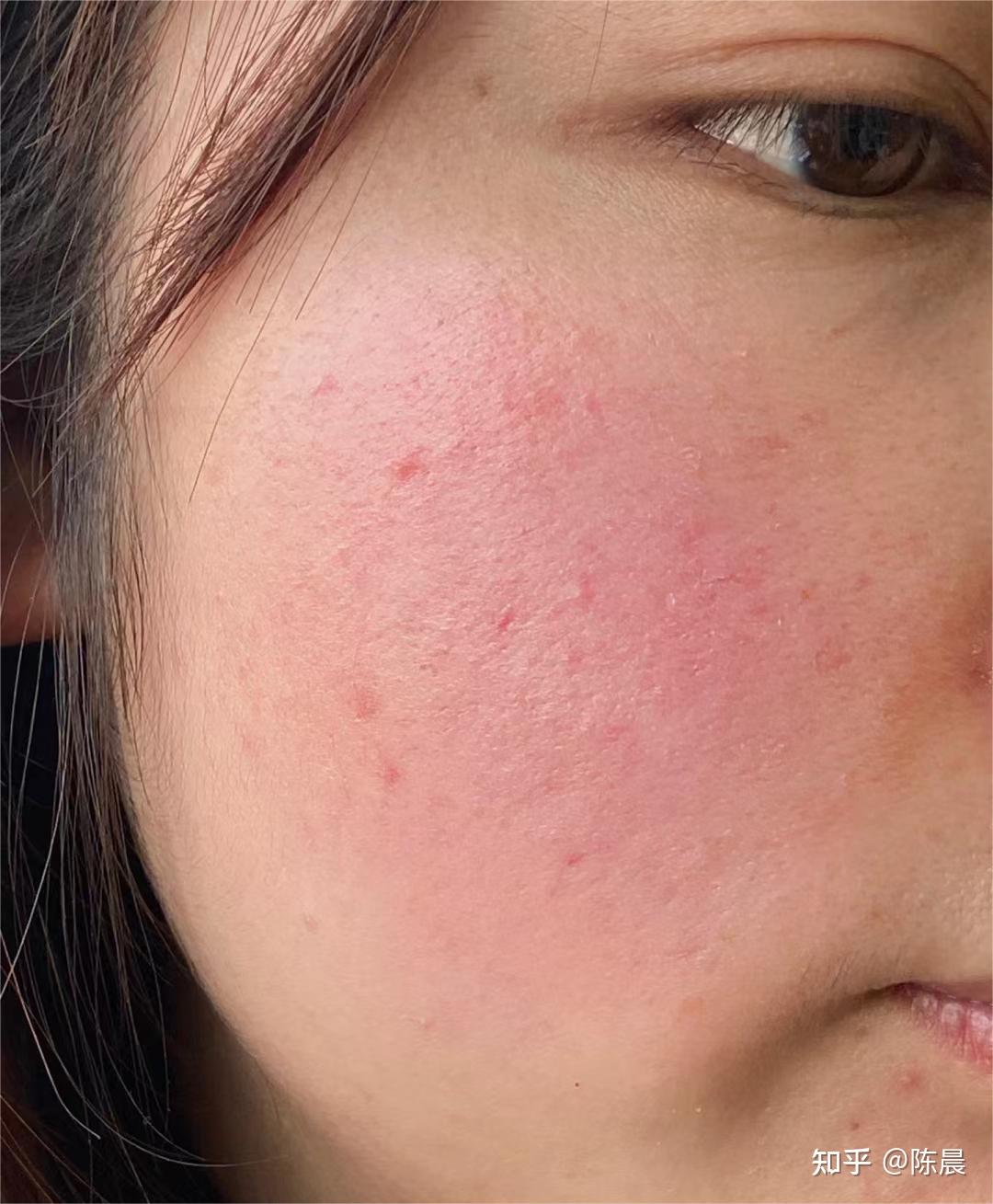 皮肤干燥泛红怎么办?如何调理肤质改善皮肤屏障受损问题?