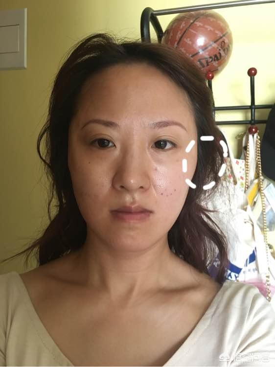 线雕后遗症变得很老线雕越做越老全脸线雕淤青变黄几天能好
