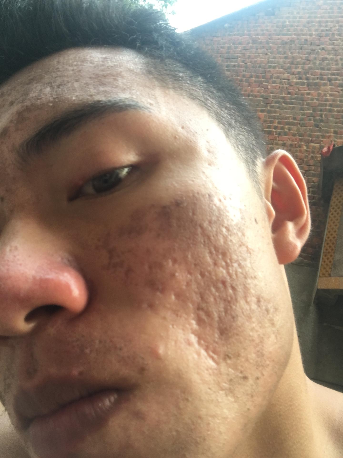 8年痘坑患者的治疗之路