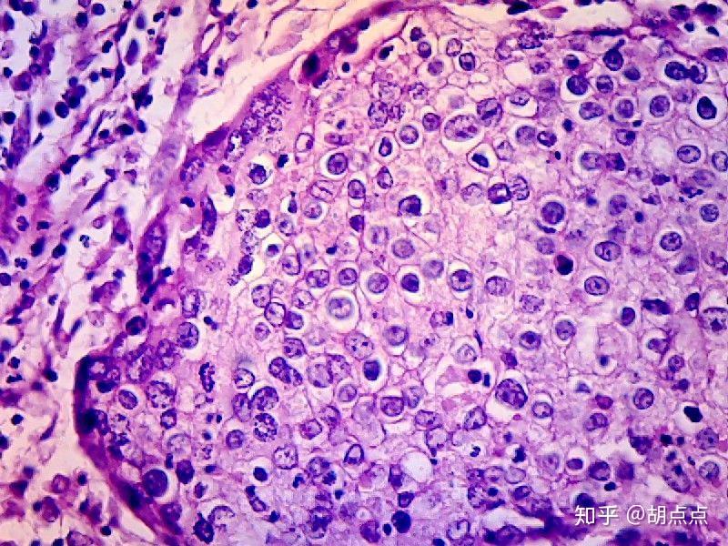 高分化鳞状细胞癌低分化鳞状细胞癌直肠腺癌平滑肌瘤平滑肌肉瘤高低倍