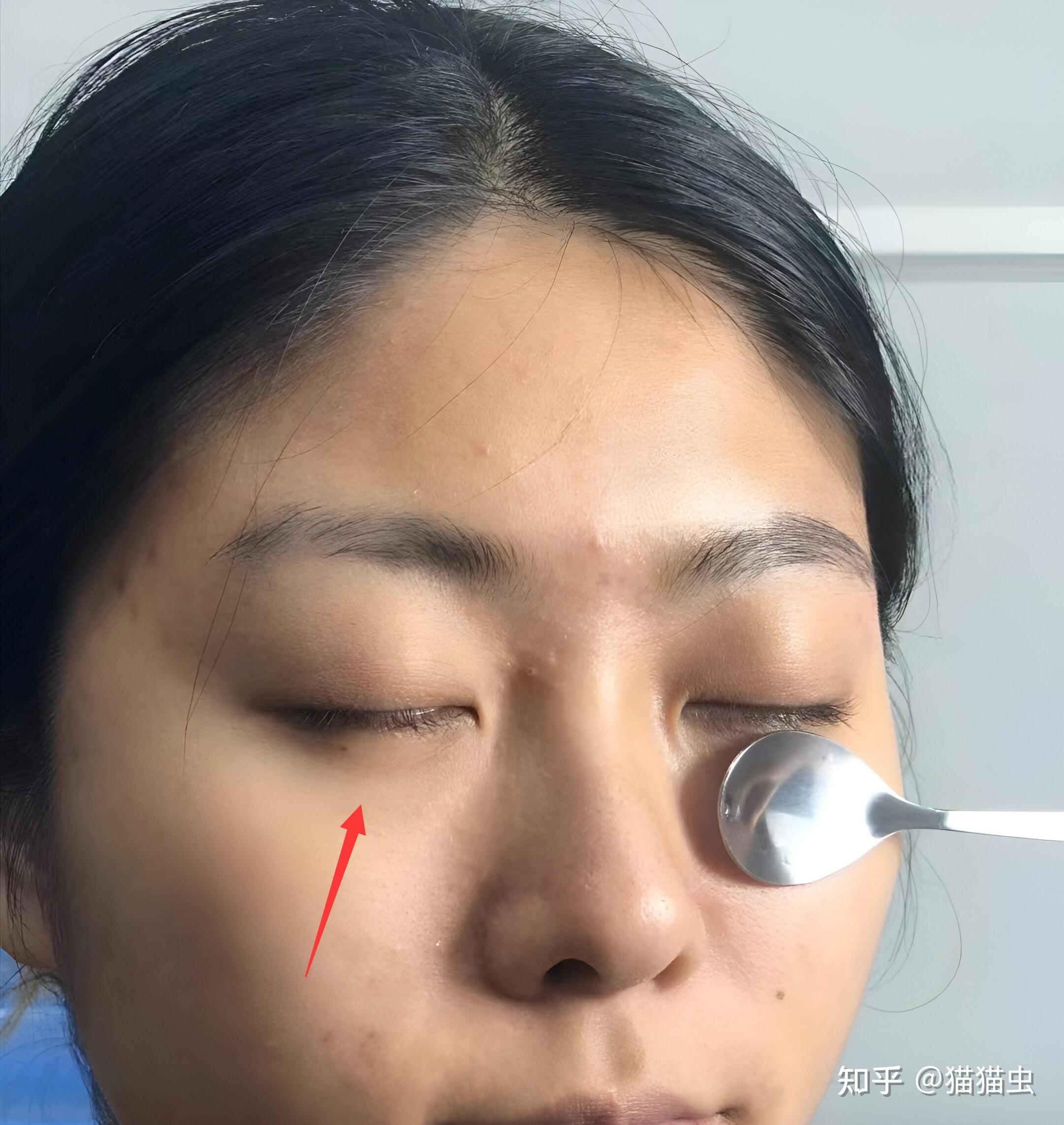 黑眼圈都快掉到下巴了有什么方法可以祛黑眼圈消除眼纹眼袋多睡觉能把